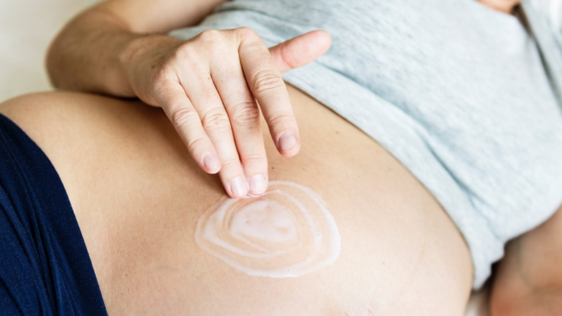 Stretch Marks – Prevention Is Better Than Cure